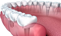  Implantes dentários, Dr. Rony Hansen - medicosrio.com.br