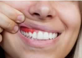 Gengiva-Periodontia. My Way Odontologia.