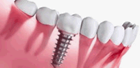 Implantes dentários, Affeto Odontologia