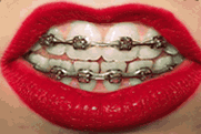 Ortodontia Aparelhos dentários. Dra Alessandra Brasil